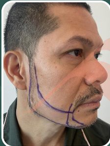 Sebelum - Beard Transplant