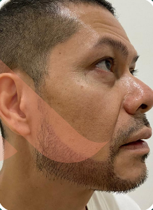 Sesudah - Beard Transplant