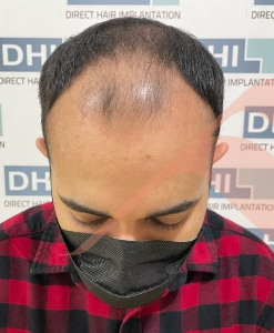 Sebelum - Hair Transplant