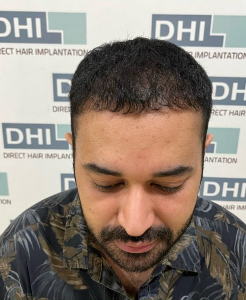 Sesudah - Hair Transplant