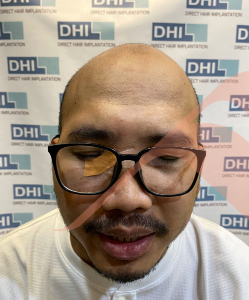 Sebelum - Hair Transplant