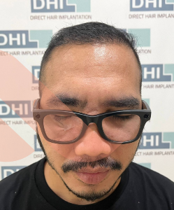 Sesudah - Hair Transplant