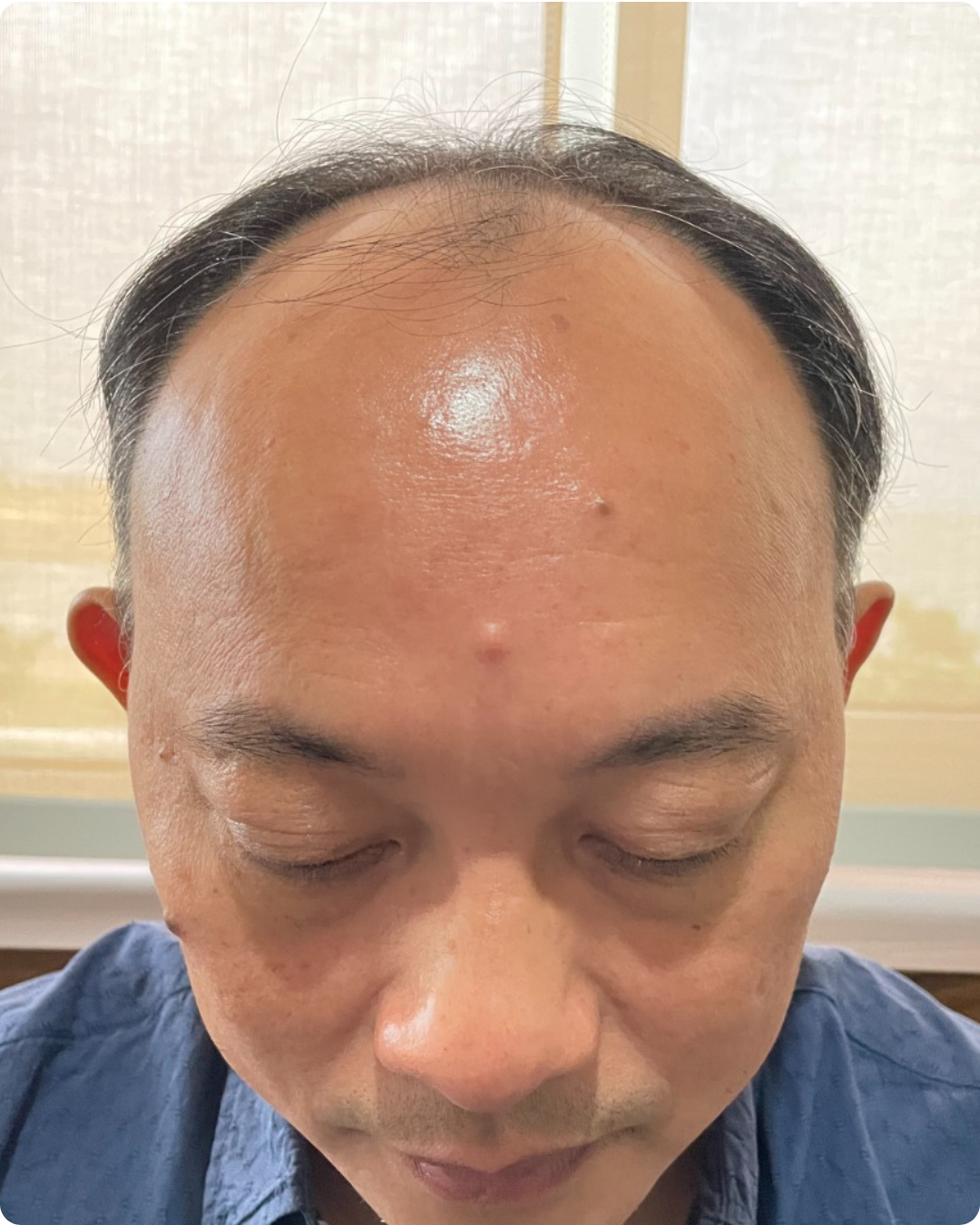 Sebelum - Hair Transplant