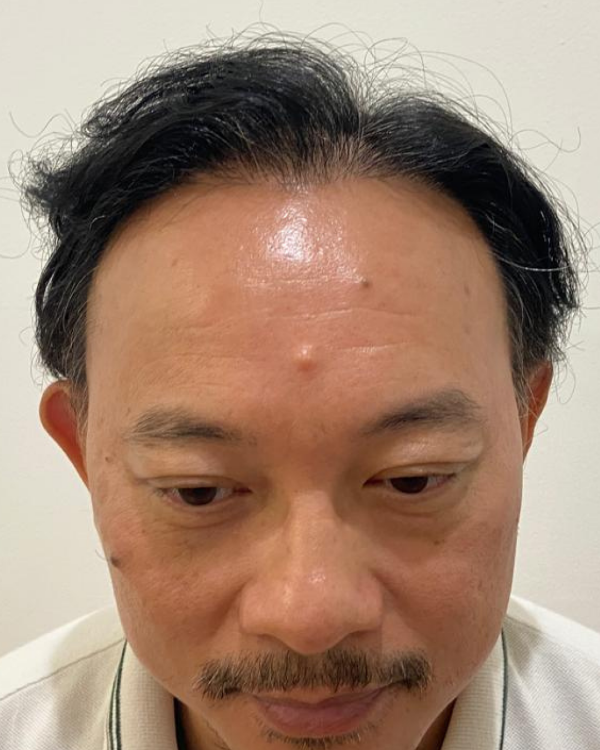 Sesudah - Hair Transplant