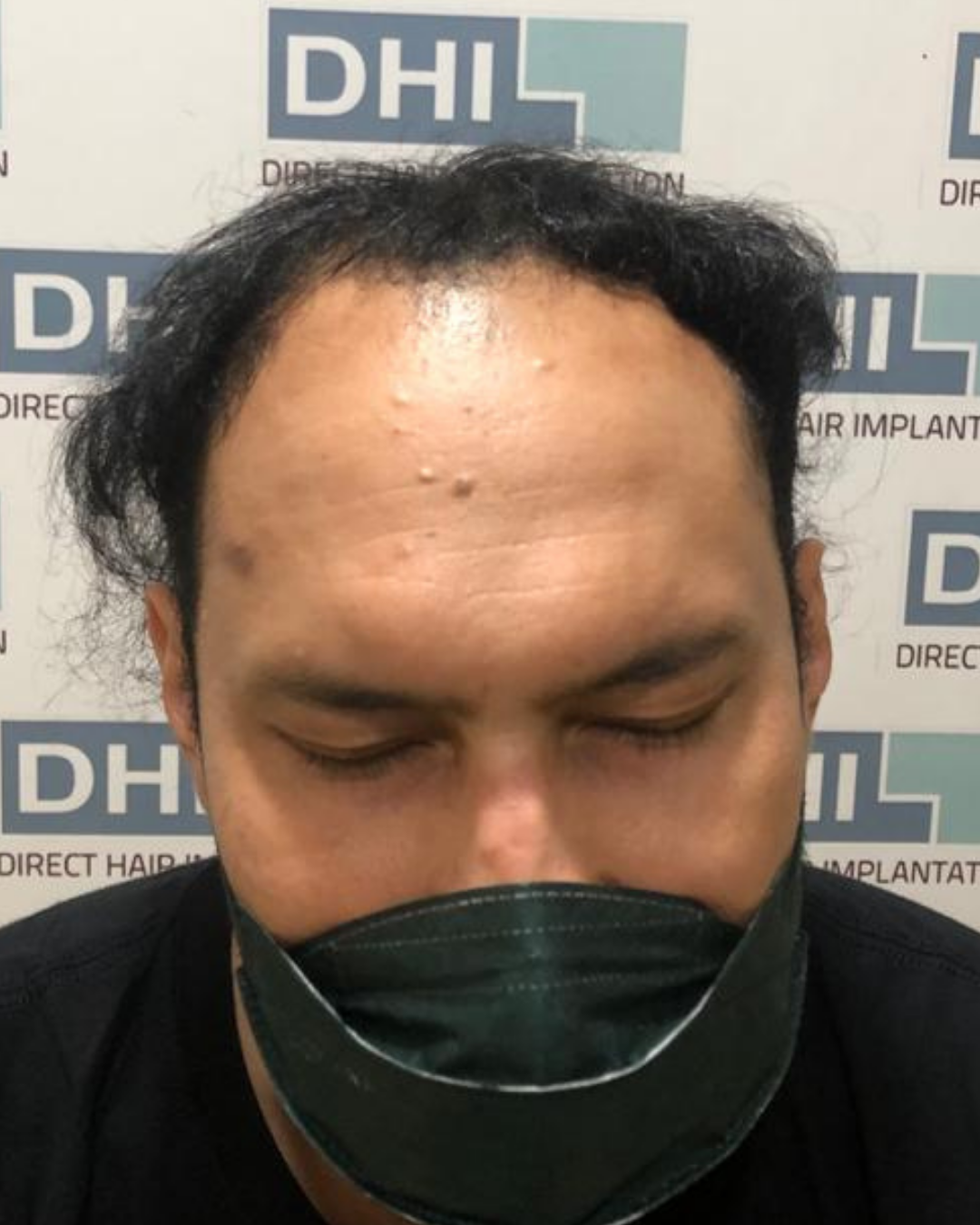 Sebelum - Hair Transplant