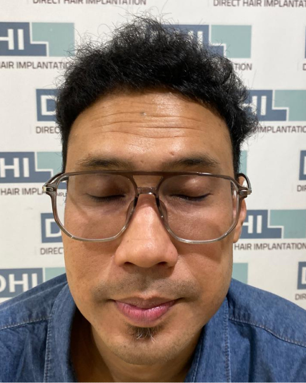 Sesudah - Hair Transplant