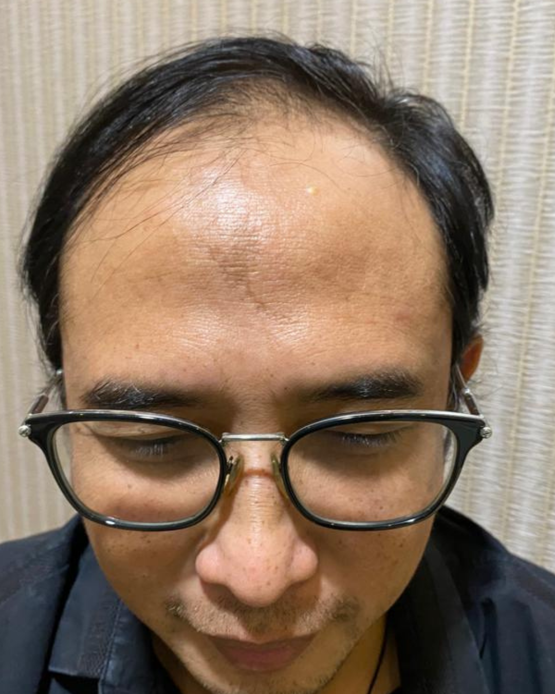 Sebelum - Hair Transplant