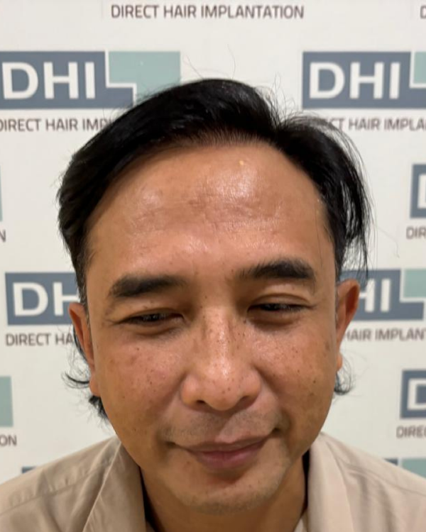 Sesudah - Hair Transplant