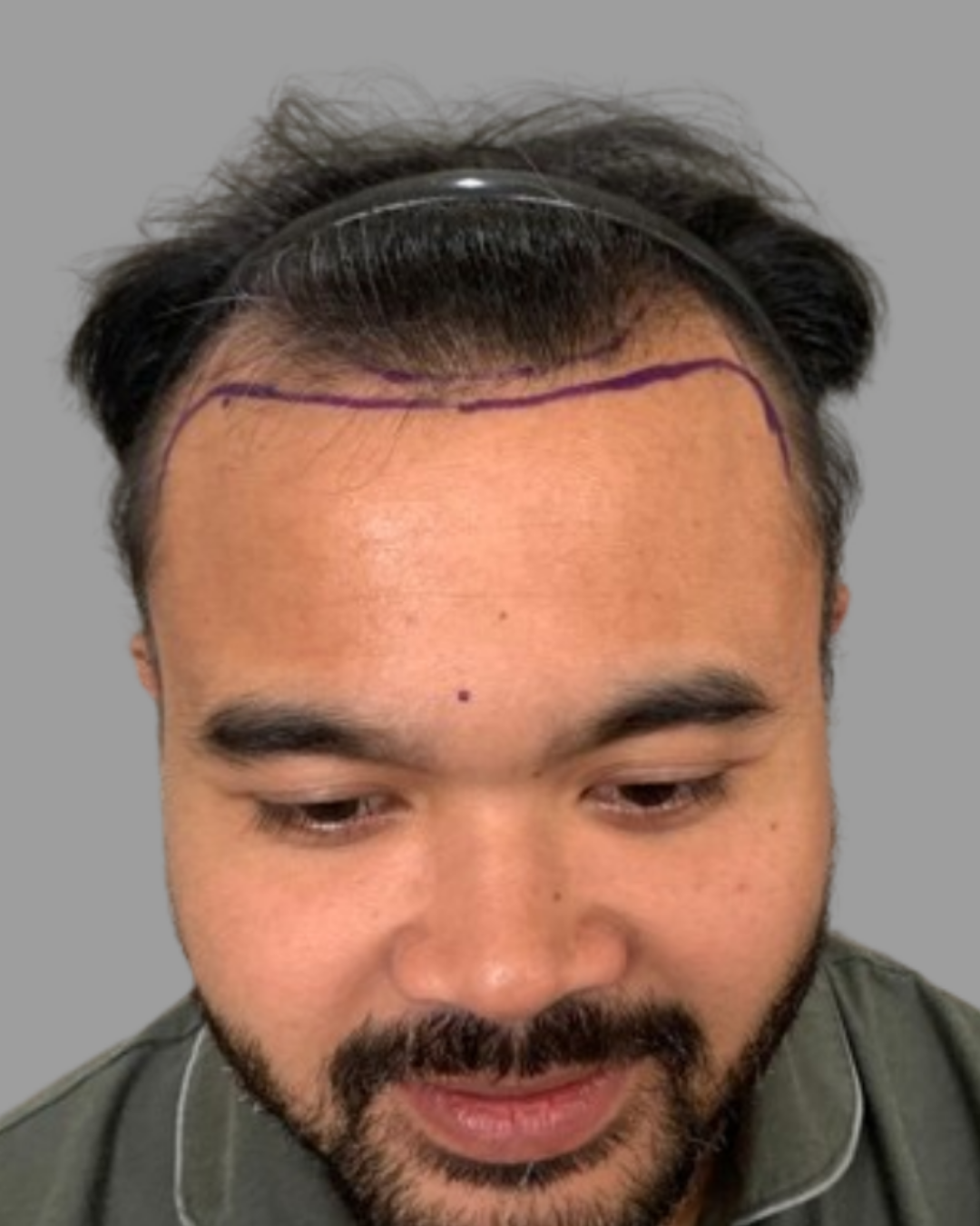 Sebelum - Hair Transplant