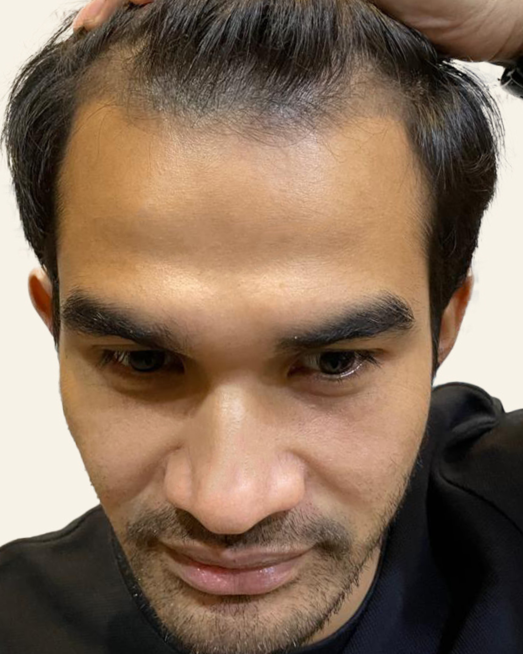 Sebelum - Hair Transplant