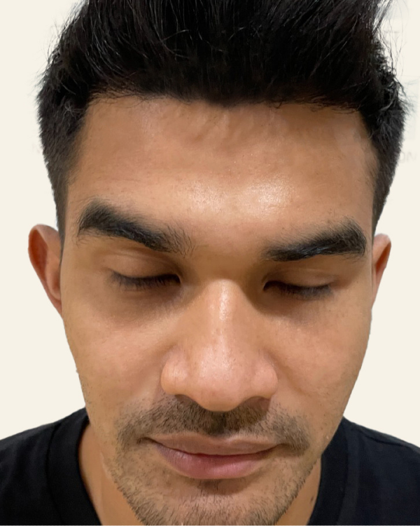 Sesudah - Hair Transplant