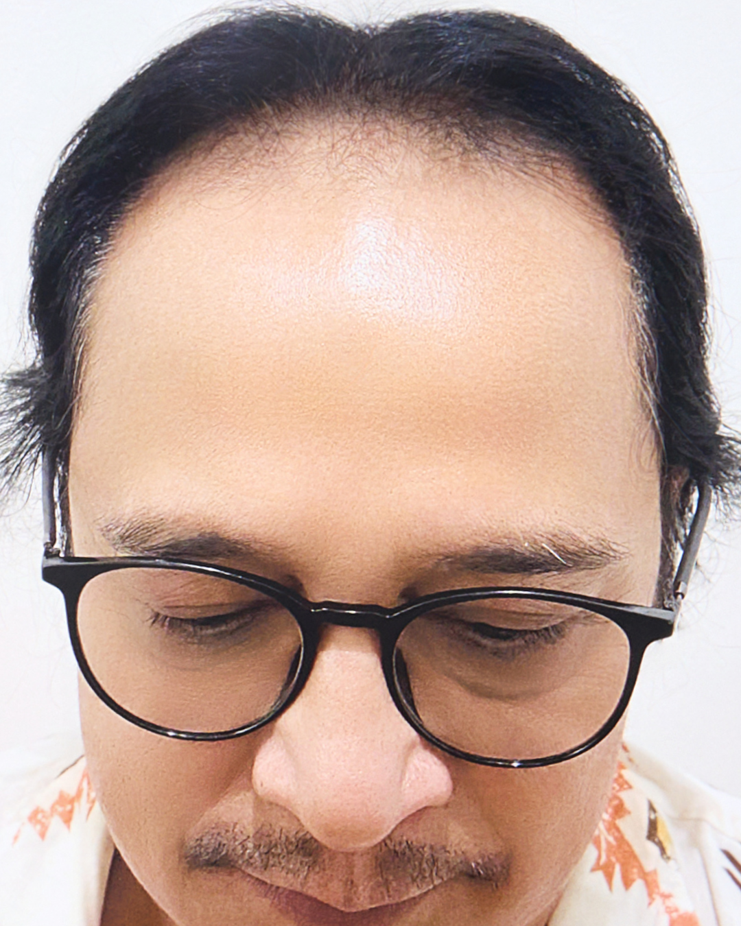 Sebelum - Hair Transplant