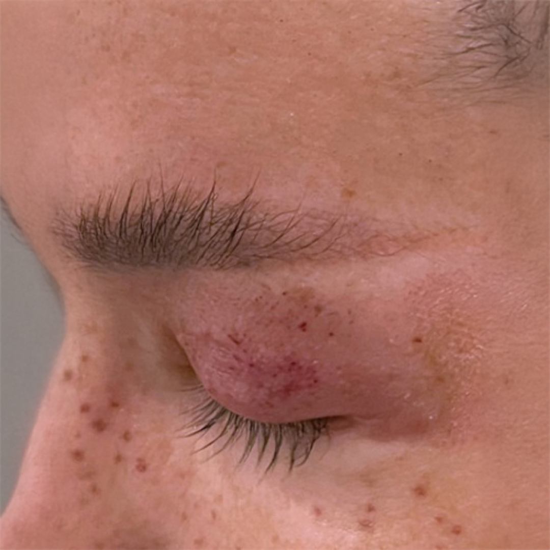 Sebelum - Eyebrow Transplant